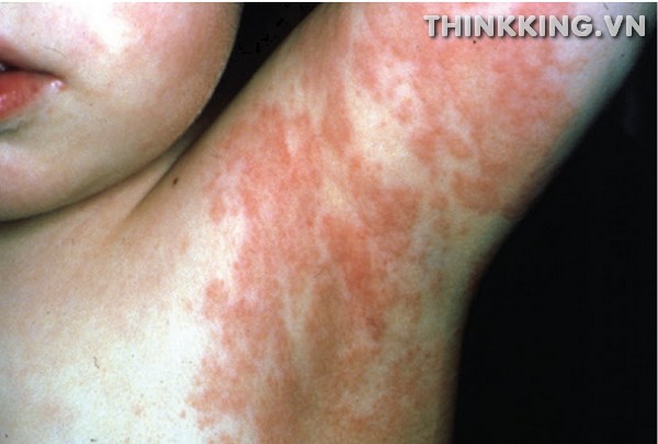 Viral Exanthem Rash: Diagnosis, Symptoms, Causes & Treatment