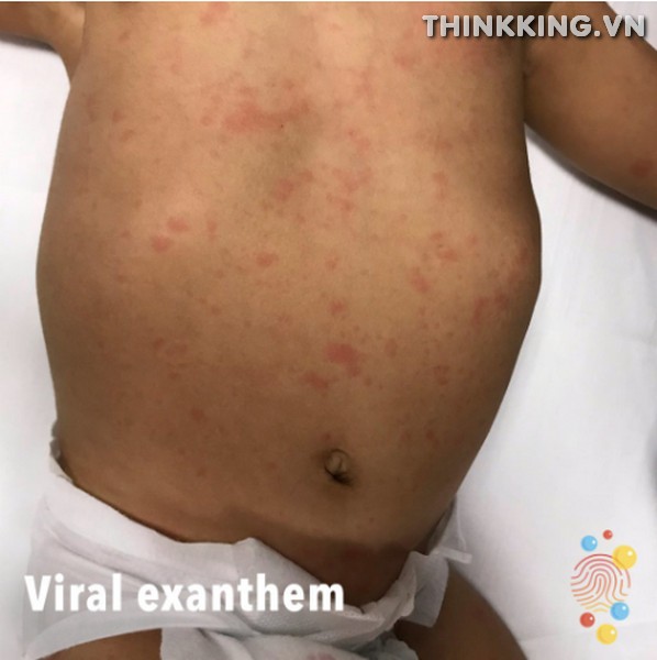 Viral Exanthem Rash: Diagnosis, Symptoms, Causes & Treatment